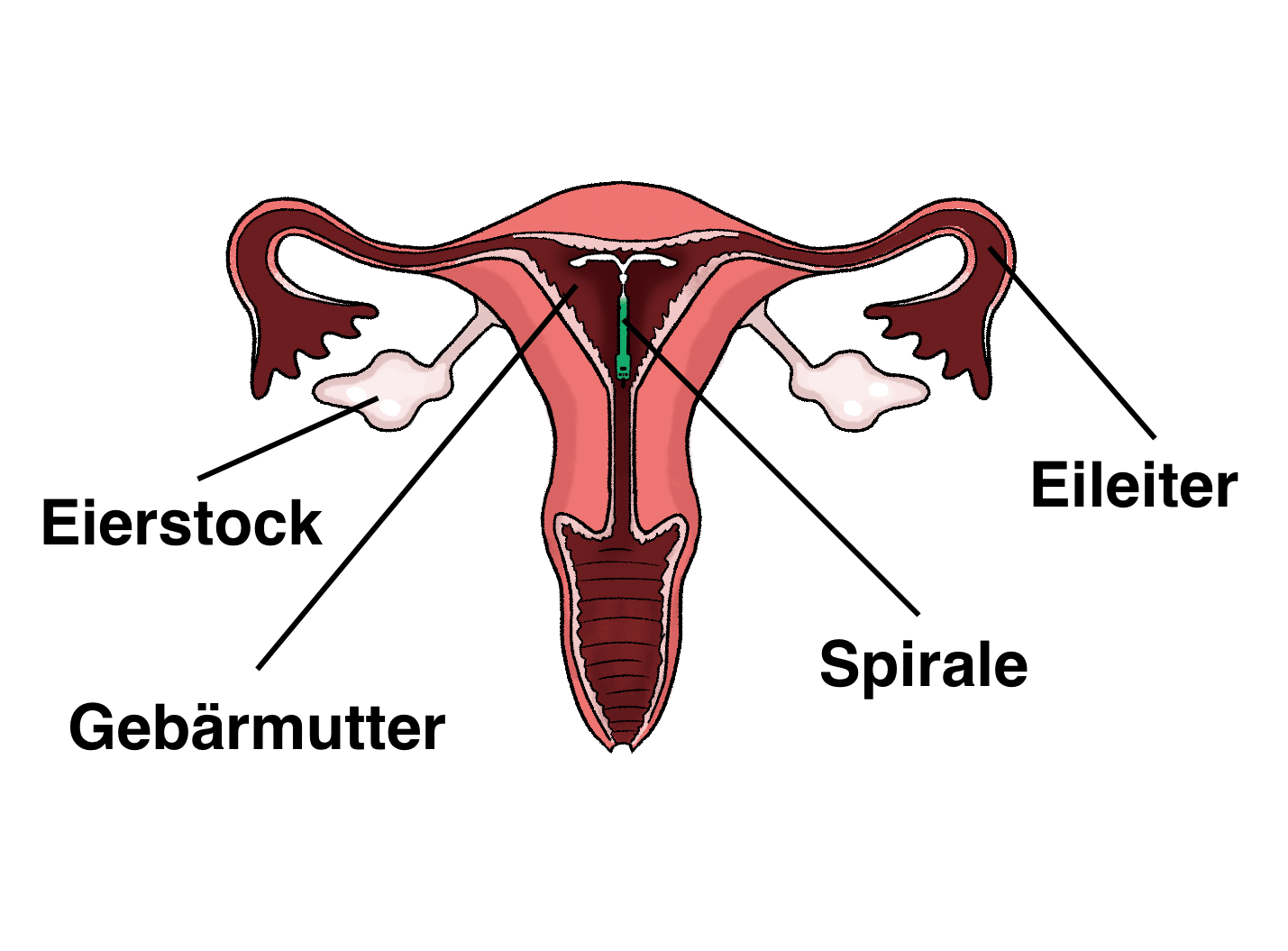 Illustration: Gebärmutter mit eingesetzter Spirale